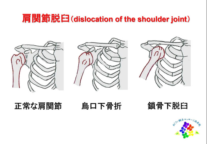 あじさい鍼灸マッサージ治療院　肩関節脱臼