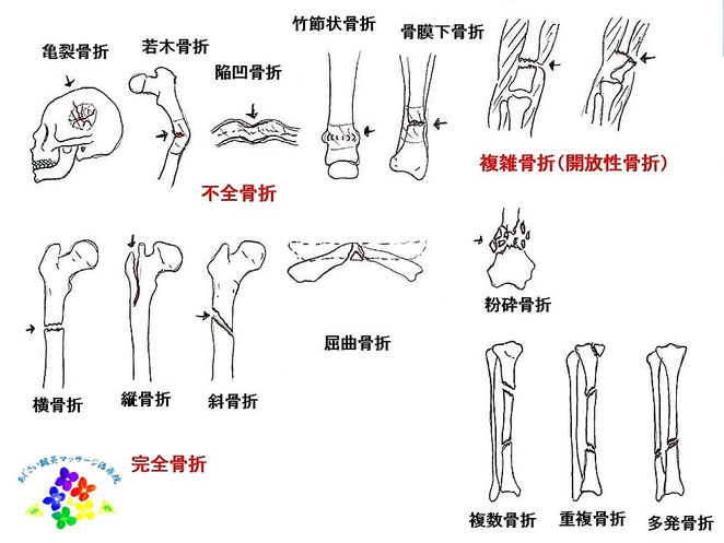 あじさい鍼灸マッサージ治療院　骨折の種類