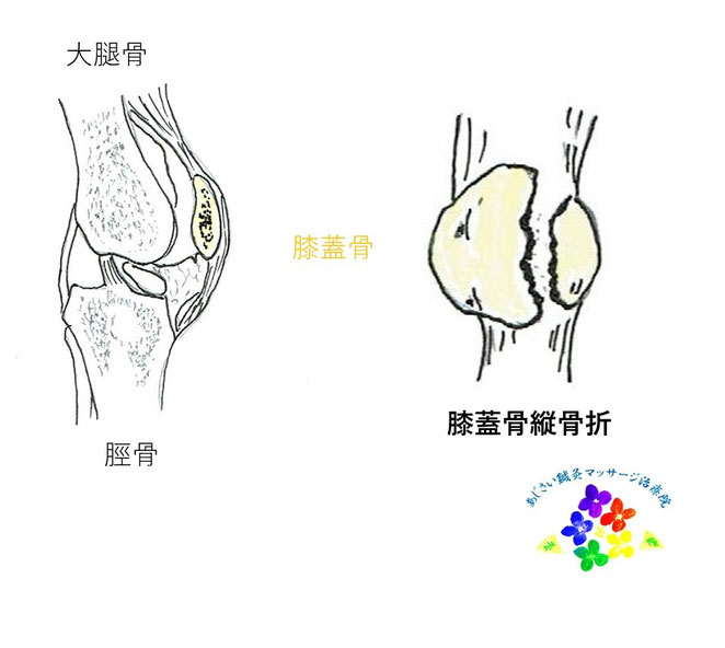 あじさい鍼灸マッサージ治療院　膝蓋骨縦骨折のイラスト