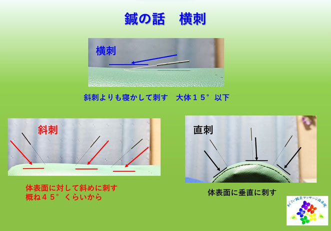 あじさい鍼灸マッサージ治療院　鍼の話　横刺