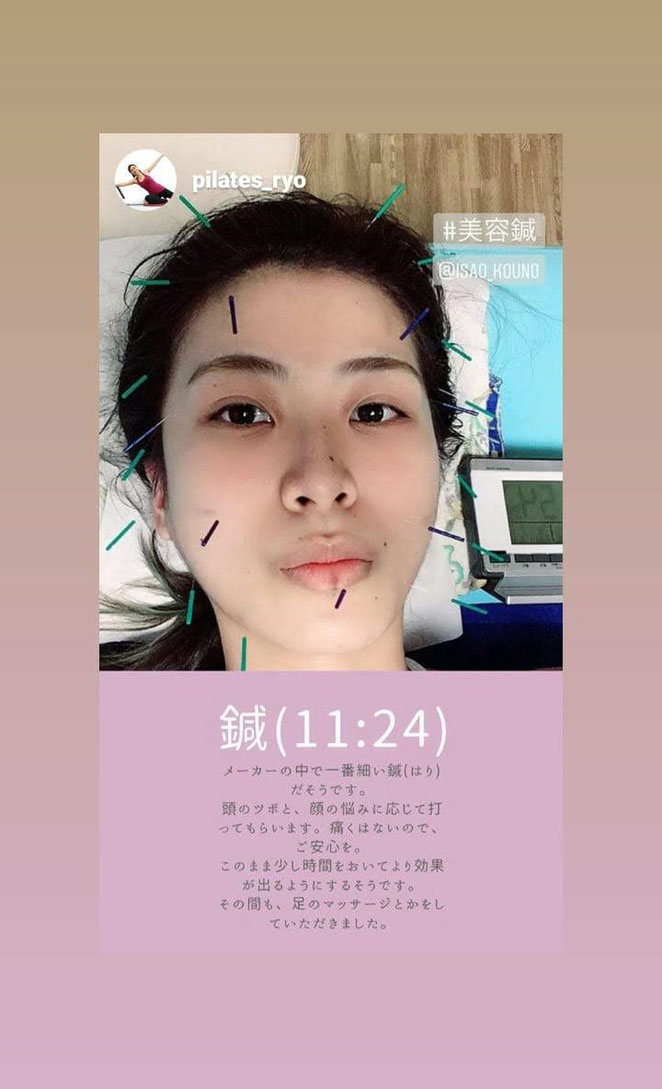 ＲＹＯさんＩｎｓｔａｇｒａｍ投稿画像より　美容鍼の様子