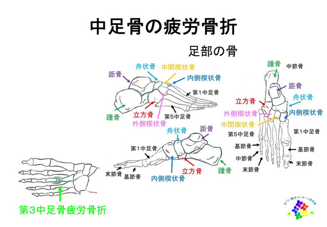 あじさい鍼灸マッサージ治療院 中足骨と疲労骨折