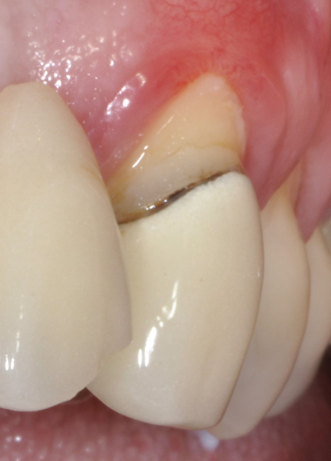 Zahnfleischrückgang - parodontosebehandlung-ahaus - sicher - schonend ...