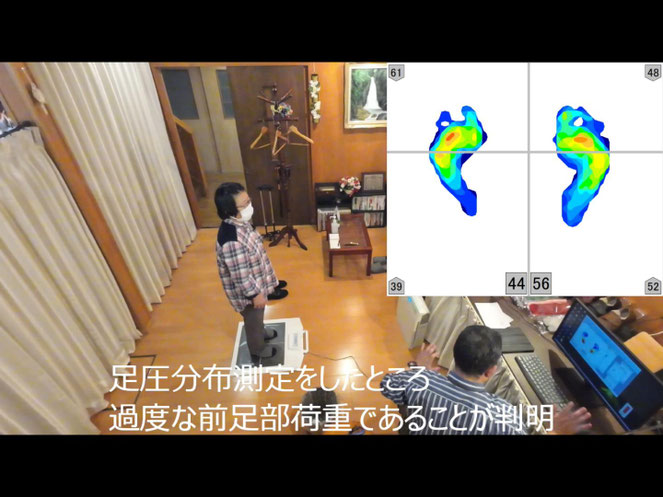 70歳代　外反母趾　女性     過度な前足部への負荷がすり足を引き起こし、  歩行に支障をきたしていましたが、骨盤の運動指導により、  踵からのスムーズな歩行に変わることができました。