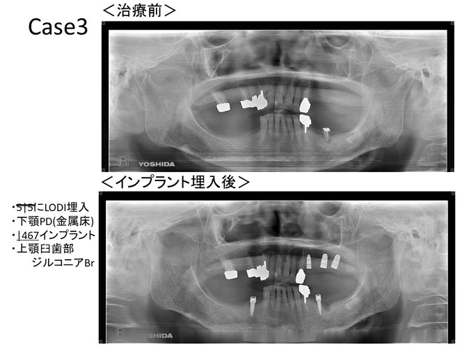 インプラントオーバーデンチャーの治療例　