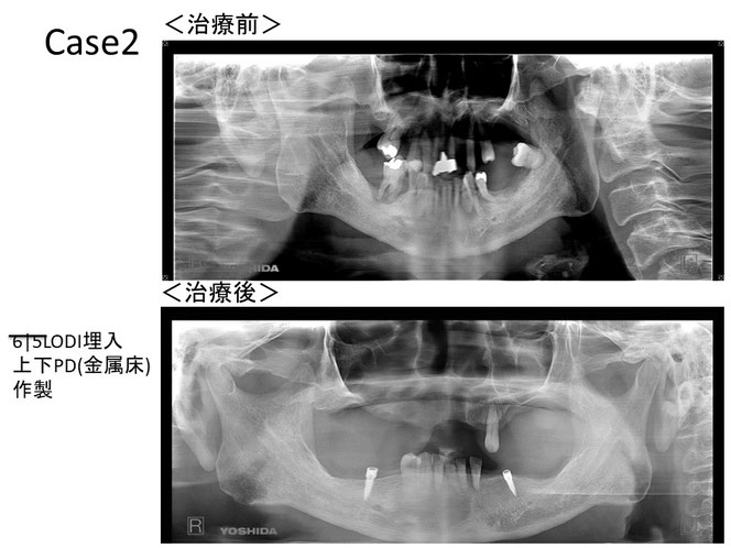 インプラントオーバーデンチャーの治療例　