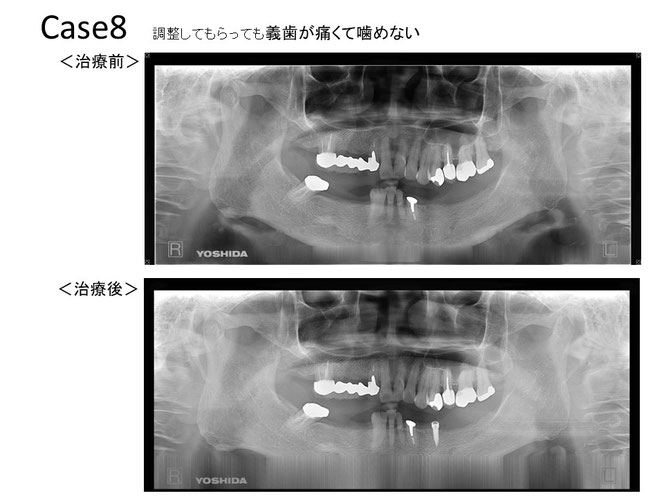 インプラントオーバーデンチャーの治療例　