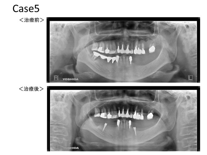 インプラントオーバーデンチャーの治療例　