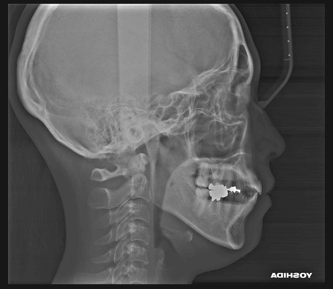下顎後退症　オープンバイト　出っ歯　マウスピース矯正の失敗例　治療後