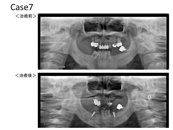 インプラントオーバーデンチャーの治療例　