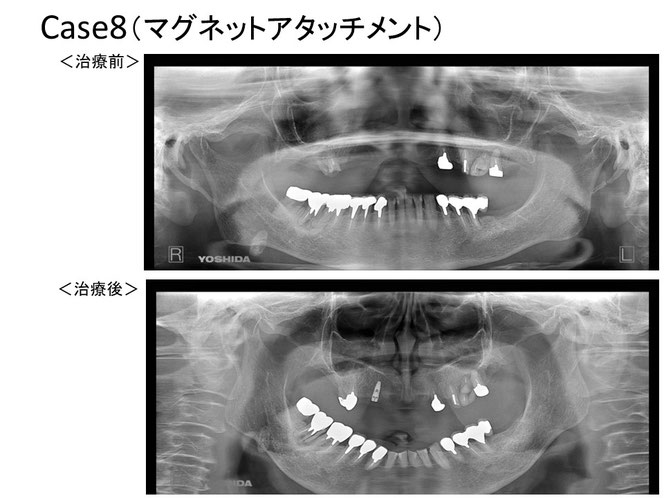 インプラントオーバーデンチャーの治療例　