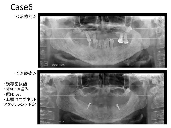 インプラントオーバーデンチャーの治療例　