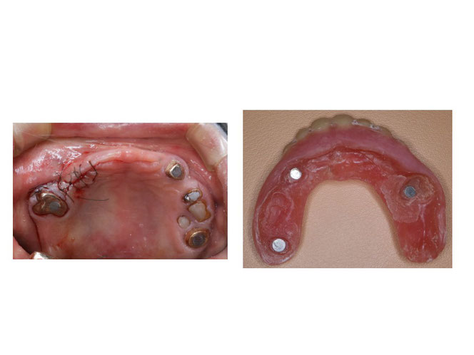 インプラントオーバーデンチャーの治療例　