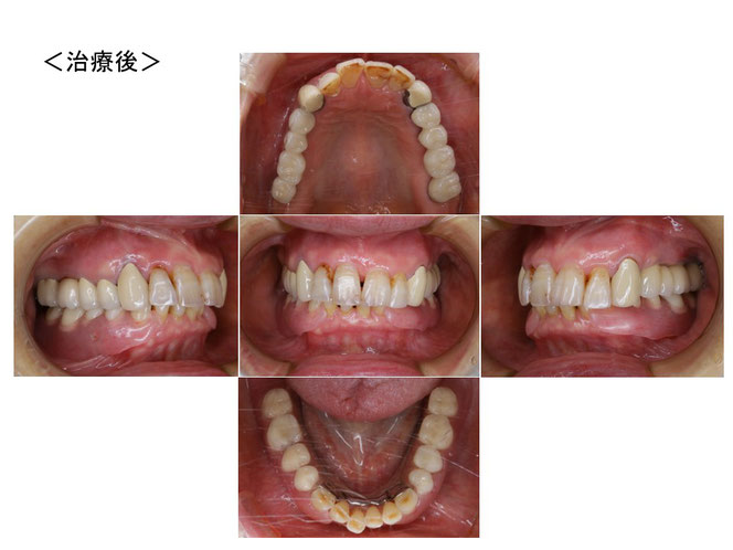 インプラントオーバーデンチャーの治療例　