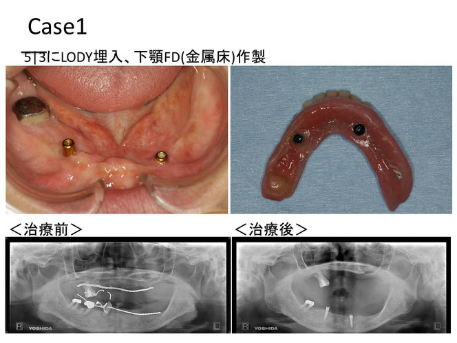 インプラントオーバーデンチャーの治療例