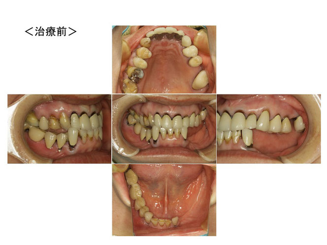 インプラントオーバーデンチャーの治療例　
