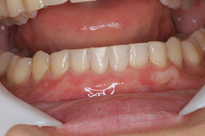 リグロスを併用した歯茎の再生治療　