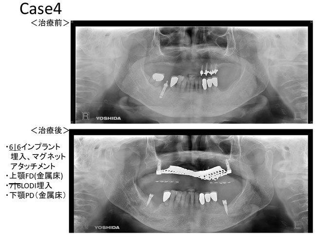 補綴臨床別冊 知っておくべきインプラントオーバーデンチャー