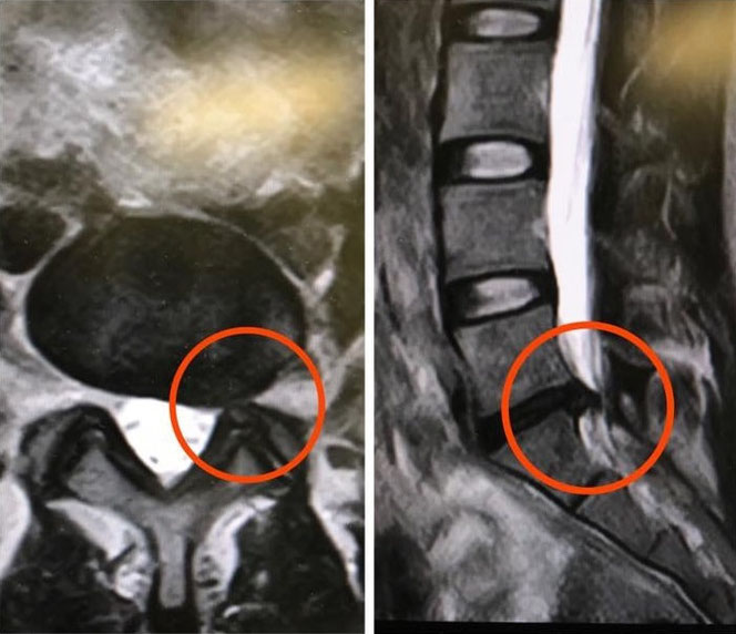 腰椎ヘルニアのMRI画像
