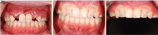 失われた永久歯もインプラント治療により違和感なく自然な自分の歯を取り戻すことができます