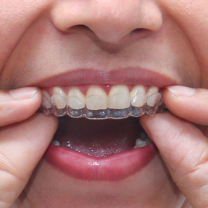 Usamos lo ultimo en Ortodoncia Invisible Tener en cuenta que estos tratamientos de ortodoncia NOVEDOSOS son con férulas transparentes removibles NO USA BRACKETS no raspa ni mancha sus dientes, y puede comer lo que realmente se le antoja sin temores