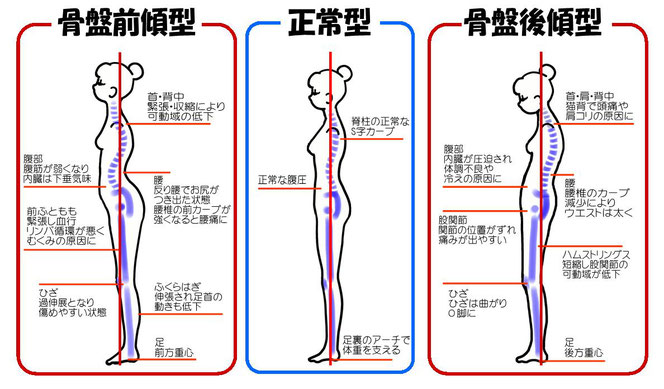 骨盤・猫背矯正