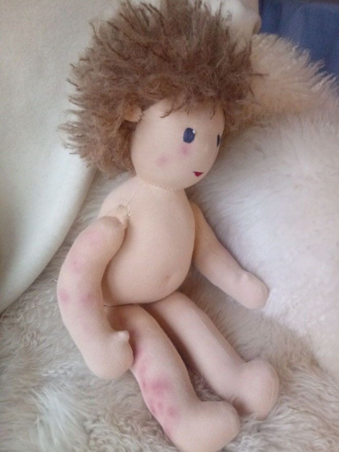 Bio-Stoffpuppe, Puppenhandwerk, Waldorfart, Wunschpuppe, individuelle Puppe passend zum Kind, handgemachte Puppe, Puppenfreund, Puppe für Kind mit Gefäßerkrankung, Puppe mit roten Flecken, aufgemalt, Immunreaktion, Seelentröster, PuppeLeberfleck,Muttermal