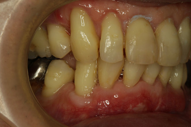 歯周病と歯ぐき再生
