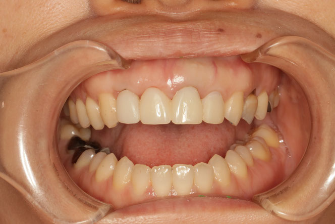 歯茎の再生　６１　歯茎の再生とオールセラミックブリッジケース