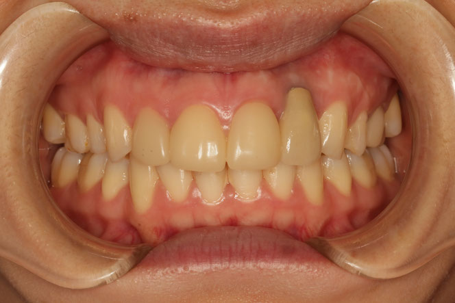 歯茎再生　No.６３　前歯のインプラントの歯茎を回復したケース