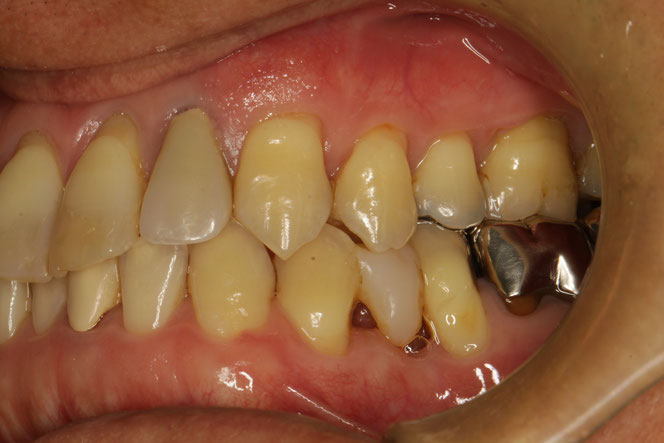 歯ぐきの再生治療