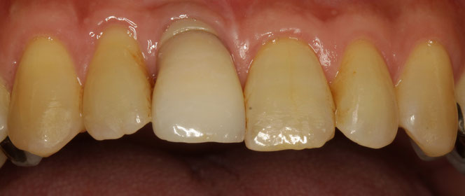 インプラントの歯茎再生