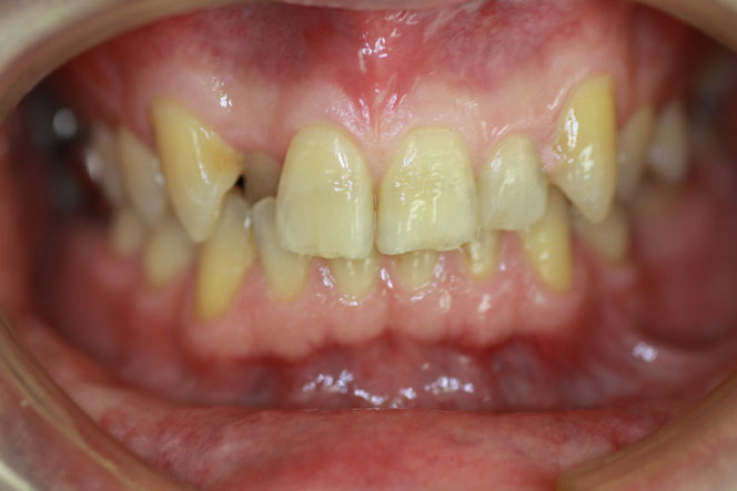 歯並び治療前