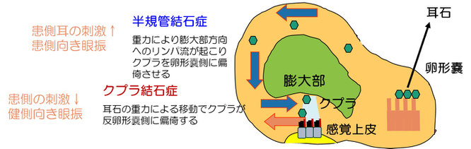 外側半規管型良性発作性頭位めまい症