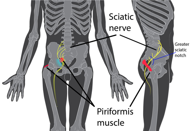 *Piriformis=梨状筋、Sciatice nerve=坐骨神経