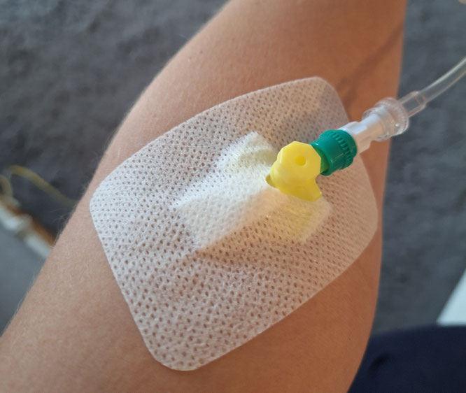 Arm mit Infusionskanüle