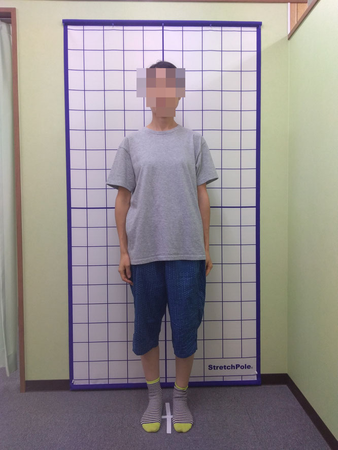 O脚患者さんの姿勢検査