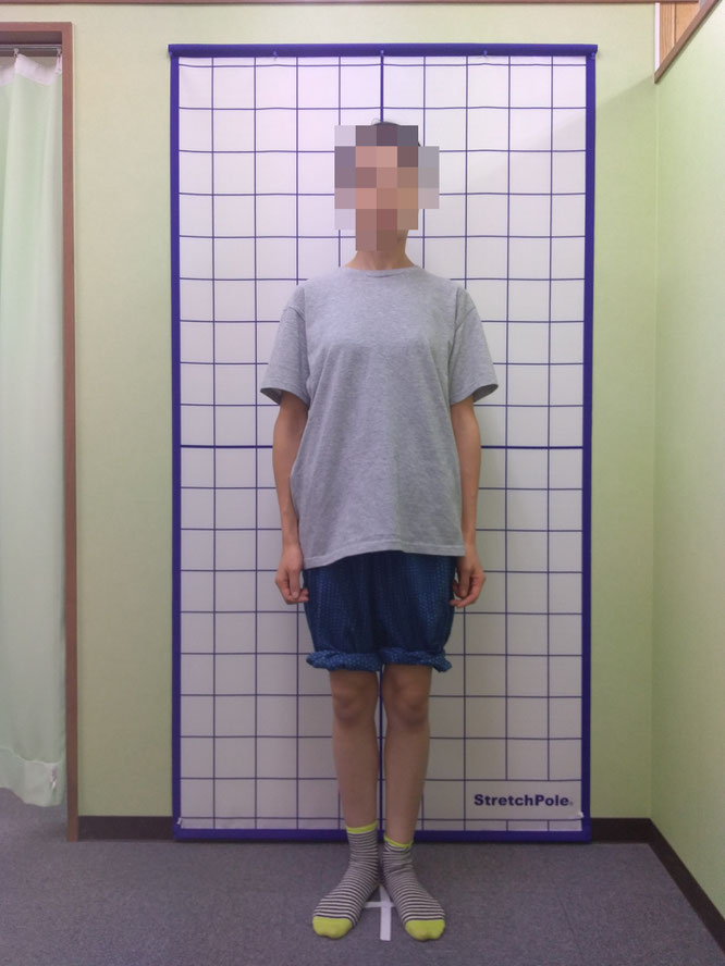 O脚患者さんの姿勢検査