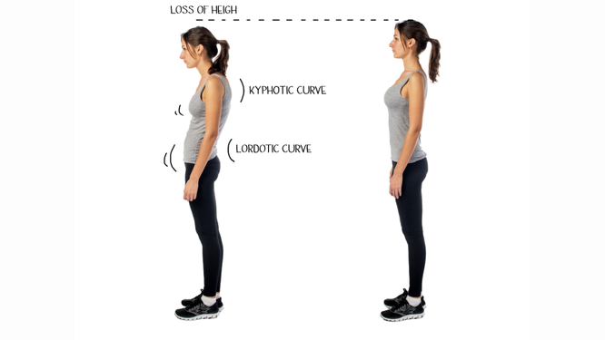 肩こり(首こり)や腰痛の原因は椎間板のズレや歪み
