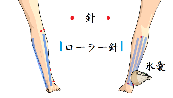 足の痛み治療図