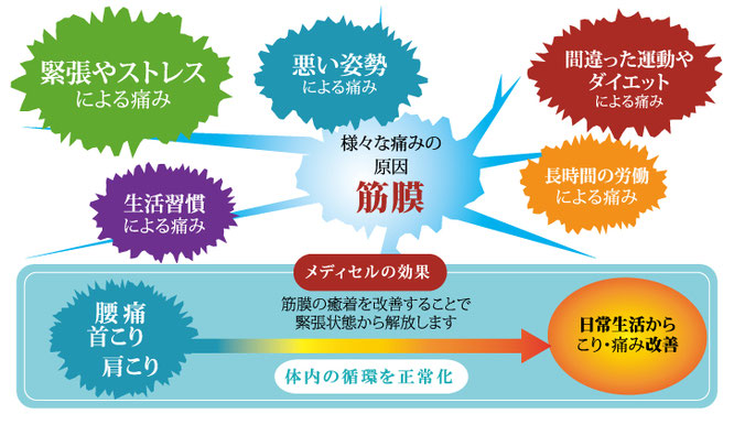 様々な痛みの原因　筋膜