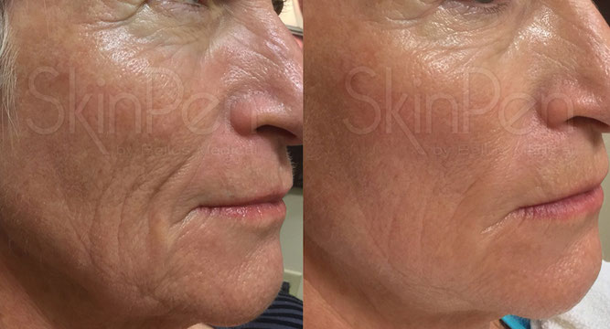 Wrinkles reduction before and after microneedling treatments