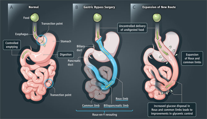 Dr. Joseph Morris III and the team at CPM Advanced Surgical Specialists are located in Newnan and specialize in gastric bypass surgery.