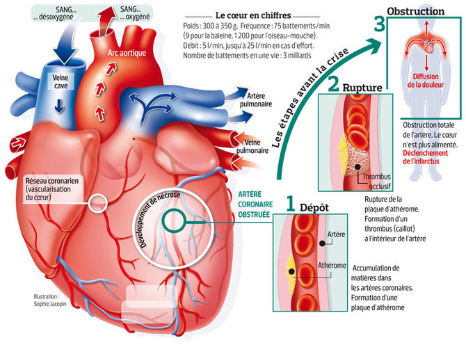 Récapitulatif du déroulement d'une crise cardiaque.