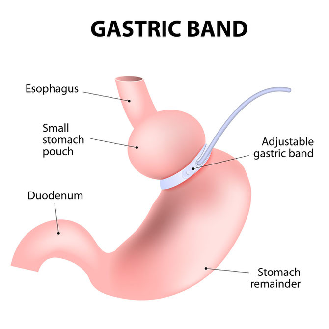 Gastric Band can be performed by Dr. Joseph Morris in Newnan, Georgia. Dr. Morris performs this procedure at Piedmont Newnan Hospital.