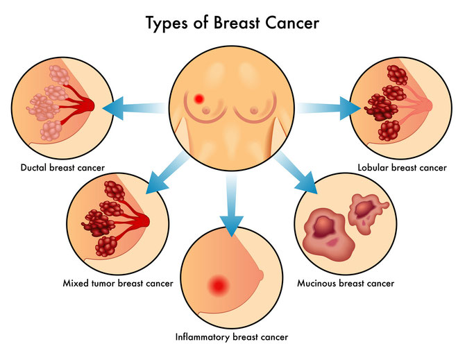 Ductal breast cancer, lobular breast cancer, inflammatory breast cancer, mucinous breast cancer and mixed tumor breast cancer are all types of breast cancer. 