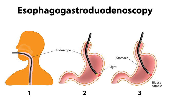 CPM Advanced Surgical Specialists are the experts when it comes to performing EGD. EGD is used to diagnose problems of the upper gastrointestinal tract (UGI) tract. 