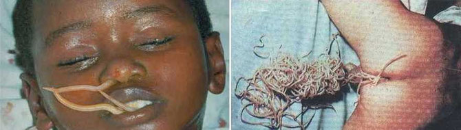 A gauche: enfant parasité dont les ascaris fuient après traitement. A droite: mort et rejet des ascaris par l'anus après traitement. Sources: internet