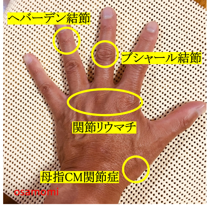 オサモミ整体院 ヘバーデン結節 ブシャール結節