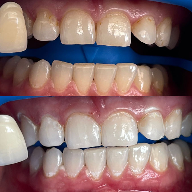 Bleaching Kosten & Info's beim Zahnarzt in Bern ZahnInsel